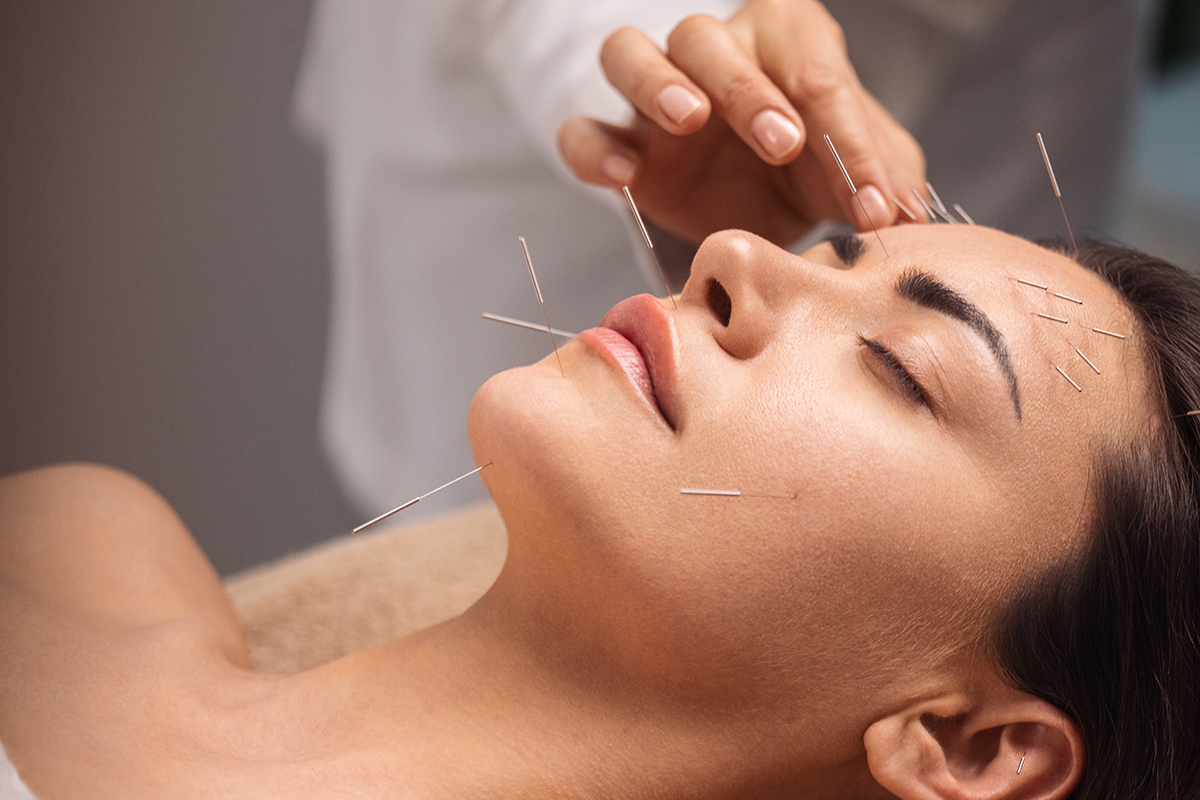 ACUPUNTURA